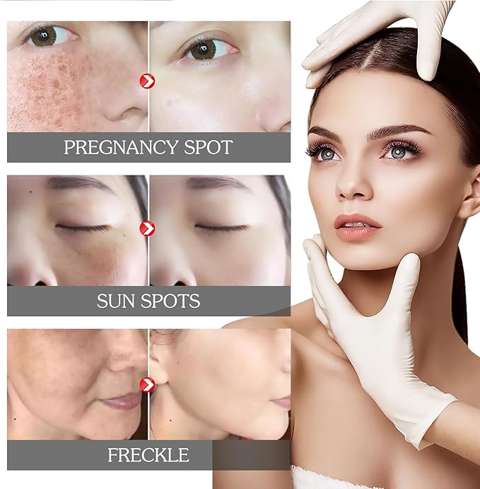 Gleamify™-EELHOE Pigment Correcting Cream-Dark Spot Remover & Skin Brightening Moisturizer (30g) - Coolmania